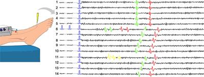 Decoding Neuropathic Pain: Can We Predict Fluctuations of Propagation Speed in Stimulated Peripheral Nerve?